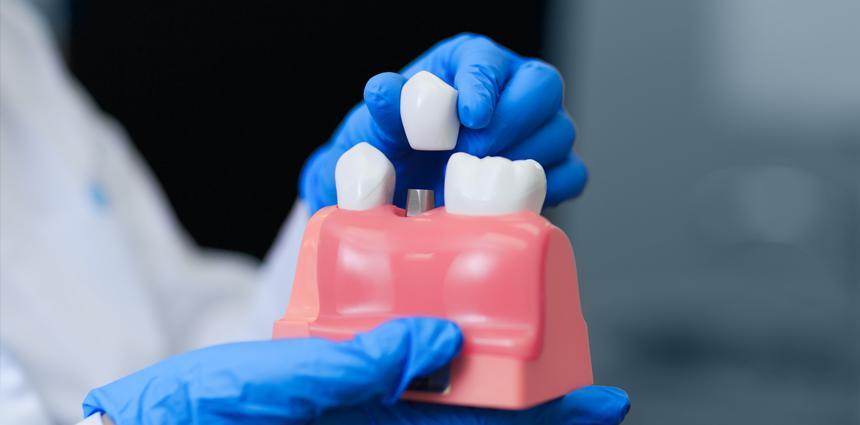 teeth implimentation