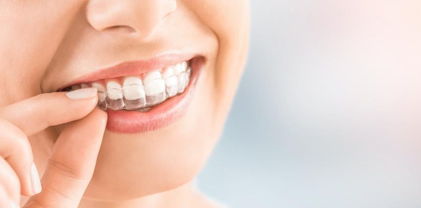 teeth caping image