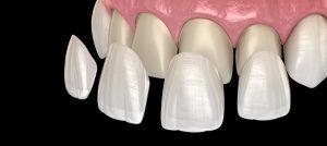 Veneers