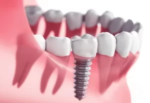 Dental Implants